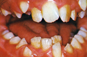 Δόντια σε λάθος θέση - Ορθοδοντικός Δρ. Ζαρμπή