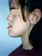 Γνάθοι που είναι δυσανάλογες με το υπόλοιπο πρόσωπο ως προς το μέγεθος ή/και τη θέση - Ορθοδοντικός Δρ. Ζαρμπή