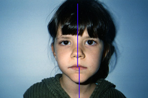 Πλαγιολίσθηση της κάτω γνάθου - Ορθοδοντικός Δρ. Ζαρμπή