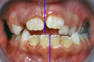 Δυσκολία στη μάσηση και το δάγκωμα - Ορθοδοντικός Δρ. Ζαρμπή