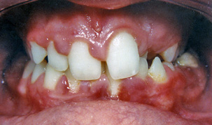 Συνωστισμένα δόντια - Ορθοδοντικός Δρ. Ζαρμπή