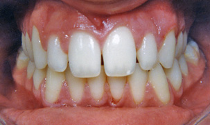 Αποτέλεσμα ορθοδοντικής θεραπείας συνωστισμένων δοντιών - Δρ. Ζαρμπή