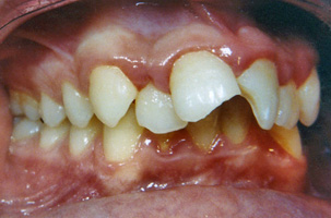 Προεξέχοντα δόντια - Ορθοδοντικός Δρ. Ζαρμπή