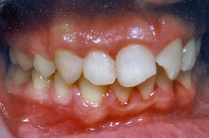 Αποτέλεσμα ορθοδοντικής θεραπείας προεξεχόντνω δοντιών - Δρ. Ζαρμπή