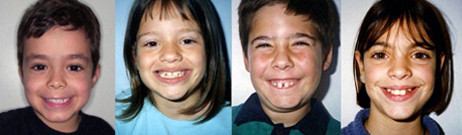 Κατάλληλη ηλικία έναρξης ορθοδοντικής θεραπείας - Δρ. Ζαρμπή