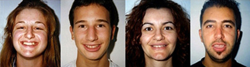 Κατάλληλη ηλικία έναρξης ορθοδοντικής θεραπείας - Δρ. Ζαρμπή