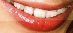 Τα κεραμικά άγκιστρα - Ορθοδοντικός Δρ. Ζαρμπή