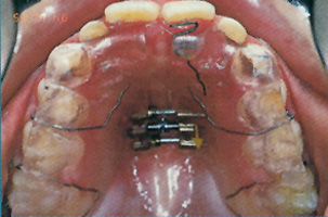 Κινητοί μηχανισμοί - Ορθοδοντικός Δρ. Ζαρμπή