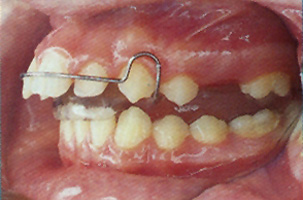 Κινητοί μηχανισμοί - Ορθοδοντικός Δρ. Ζαρμπή