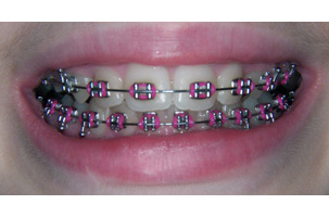 Ορθοδοντικοί Μηχανισμοί - Ορθοδοντικός Δρ. Ζαρμπή