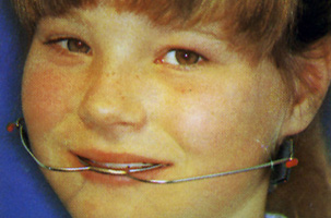 Κινητοί μηχανισμοί - Ορθοδοντικός Δρ. Ζαρμπή