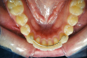 Μόνιμος μεταλλικός μηχανισμός - Ορθοδοντικός Δρ. Ζαρμπή