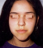 Προχειρουργική ορθοδοντική - Ορθοδοντικός Δρ. Ζαρμπή