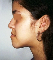 Προχειρουργική ορθοδοντική - Ορθοδοντικός Δρ. Ζαρμπή