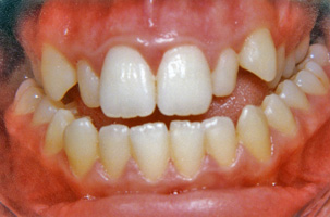 Προχειρουργική ορθοδοντική - Ορθοδοντικός Δρ. Ζαρμπή