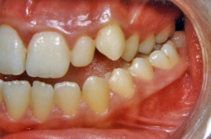 Προχειρουργική ορθοδοντική - Ορθοδοντικός Δρ. Ζαρμπή