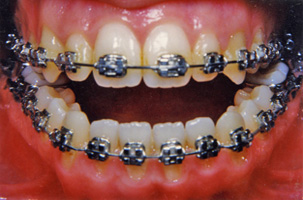 Χειρουργική επέμβαση - Ορθοδοντικός Δρ. Ζαρμπή