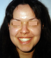 Μεταχειρουργική ορθοδοντική θεραπεία - Ορθοδοντικός Δρ. Ζαρμπή