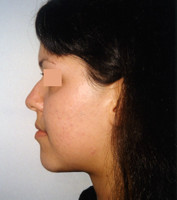 Μεταχειρουργική ορθοδοντική θεραπεία - Ορθοδοντικός Δρ. Ζαρμπή