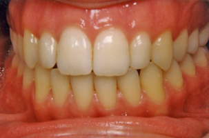 Μεταχειρουργική ορθοδοντική θεραπεία - Ορθοδοντικός Δρ. Ζαρμπή