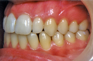 Μεταχειρουργική ορθοδοντική θεραπεία - Ορθοδοντικός Δρ. Ζαρμπή