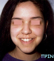 Μεταχειρουργική ορθοδοντική θεραπεία - Ορθοδοντικός Δρ. Ζαρμπή