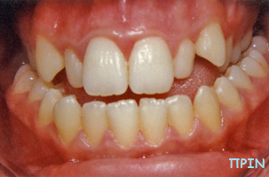 Ορθοδοντική θεραπεία Πριν - Δρ. Ζαρμπή