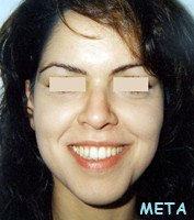 Μεταχειρουργική ορθοδοντική θεραπεία - Ορθοδοντικός Δρ. Ζαρμπή