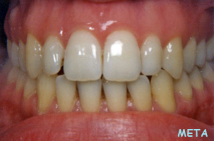 Ορθοδοντική θεραπεία Μετά - Δρ. Ζαρμπή