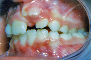 Συνωστισμένα δόντια - Ορθοδοντικός Δρ. Ζαρμπή