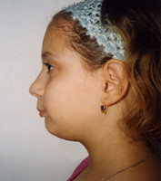 Προγναθισμός άνω γνάθου σε συνδιασμό με οπισθογναθισμό της κάτω γνάθου - Ορθοδοντικός Δρ. Ζαρμπή