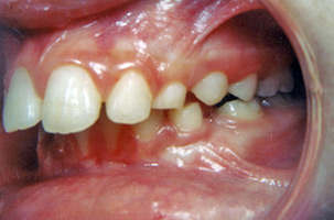 Προγναθισμός άνω γνάθου σε συνδιασμό με οπισθογναθισμό της κάτω γνάθου - Ορθοδοντικός Δρ. Ζαρμπή