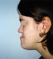 Προγναθισμός κάτω γνάθου - Ορθοδοντικός Δρ. Ζαρμπή