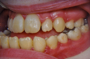 Προγναθισμός κάτω γνάθου - Ορθοδοντικός Δρ. Ζαρμπή