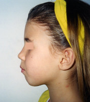 Προβλήματα στη σύγκλειση - Ορθοδοντικός Δρ. Ζαρμπή