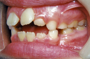 Προβλήματα στη σύγκλειση - Ορθοδοντικός Δρ. Ζαρμπή