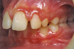 Προγναθισμός άνω γνάθου - Ορθοδοντικός Δρ. Ζαρμπή