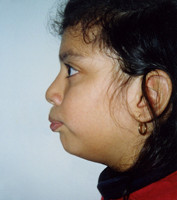 Προγναθισμός άνω γνάθου - Ορθοδοντικός Δρ. Ζαρμπή