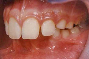 Οπισθογναθισμός της κάτω γνάθου - Ορθοδοντικός Δρ. Ζαρμπή