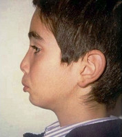 Οπισθογναθισμός της κάτω γνάθου - Ορθοδοντικός Δρ. Ζαρμπή