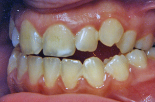 Ψευδοπρογναθισμός της κάτω γνάθου - Ορθοδοντικός Δρ. Ζαρμπή