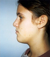 Ψευδοπρογναθισμός της κάτω γνάθου - Ορθοδοντικός Δρ. Ζαρμπή