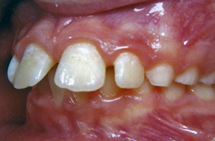 Δόντια με διαστήματα - Ορθοδοντικός Δρ. Ζαρμπή