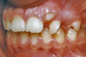 Δόντια σε ετεροτοπία - Ορθοδοντικός Δρ. Ζαρμπή