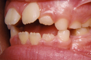 Δόντια χωρίς επαφή μεταξύ τους - Ορθοδοντικός Δρ. Ζαρμπή