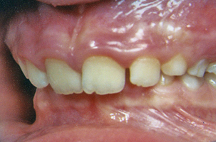 Υπερσύγκλειση - Ορθοδοντικός Δρ. Ζαρμπή