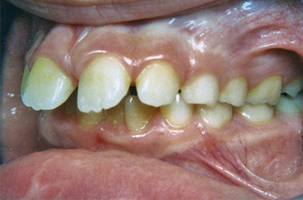 Προεξέχοντα άνω δόντια - Ορθοδοντικός Δρ. Ζαρμπή