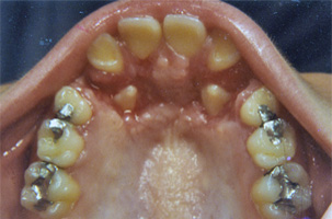 Έγκλειστα δόντια - Ορθοδοντικός Δρ. Ζαρμπή