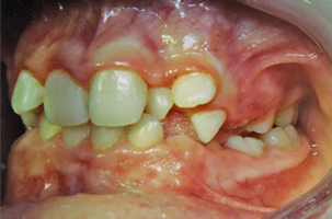 Υπεράριθμα δόντια - Ορθοδοντικός Δρ. Ζαρμπή