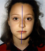 Σταυροειδής σύγκλειση - Ορθοδοντικός Δρ. Ζαρμπή